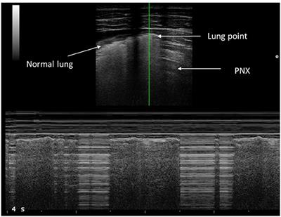 Lung Ultrasound to Detect Pneumothorax in Children Evaluated for Acute Chest Pain in the Emergency Department: An Observational Pilot Study